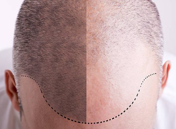 Top view of a men's head with a receding hair line - Before and After